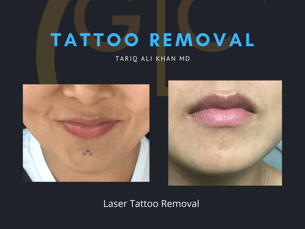 Gentle Care Laser Tustin Before and After picture - Tattoo Removal